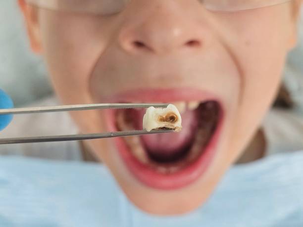 Best Emergency Root Canal Therapy in Heyworth, IL